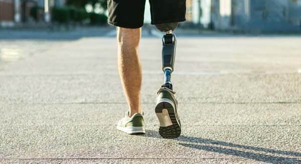 Man walking with prosthetic leg after amputation